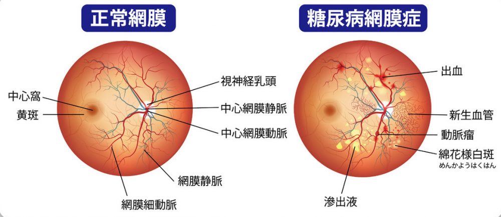 糖尿病網膜症｜盛岡のたかはし眼科